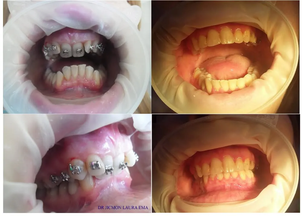 Patru fotografii intraorale: dantura cu aparat dentar fix și aceeași dantură după tratament