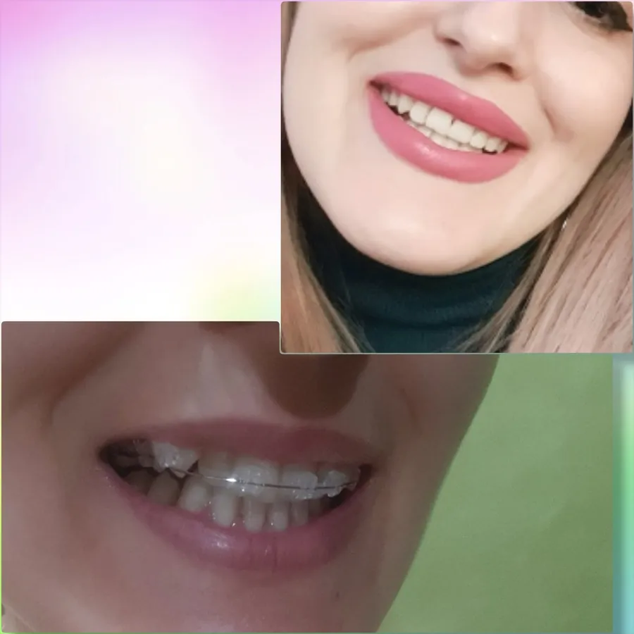 Același zâmbet în timpul tratamentului, cu aparat dentar, și după scoaterea aparatului